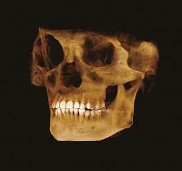 Компьютерная томография лица