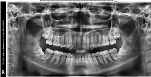 Снимок компьютерная томография зубов